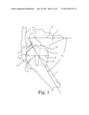 BONE PREPARATION TOOL KIT AND ASSOCIATED METHOD diagram and image