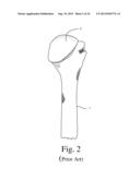 BONE PREPARATION TOOL KIT AND ASSOCIATED METHOD diagram and image