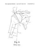 BONE PREPARATION TOOL KIT AND ASSOCIATED METHOD diagram and image