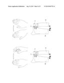 PROSTHESIS FOR DISTAL RADIOULNAR JOINT diagram and image