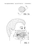 Cheek pouch anchor diagram and image