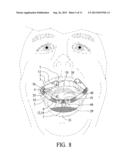 Cheek pouch anchor diagram and image