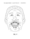 Cheek pouch anchor diagram and image