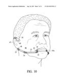 Cheek pouch anchor diagram and image