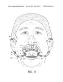 Cheek pouch anchor diagram and image