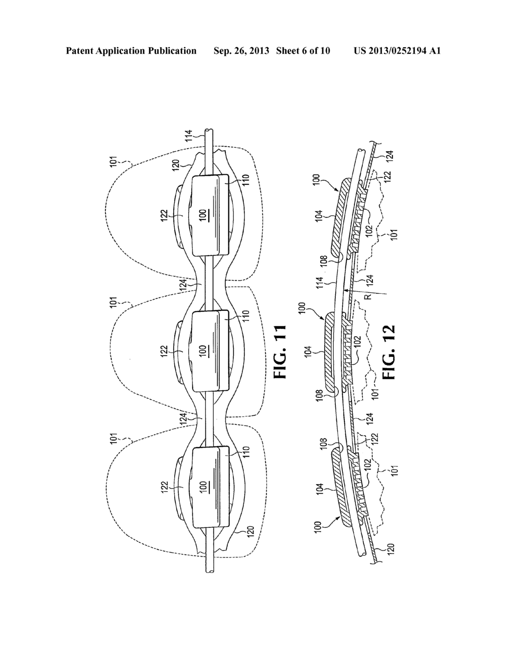 Orthodontic Applicance with Radiused Wire Slot - diagram, schematic, and image 07