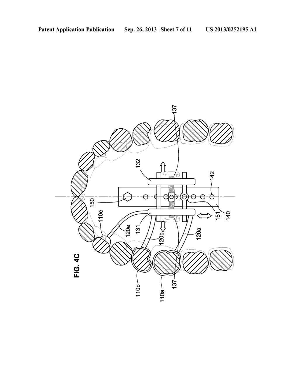 ORTHODONTIC EXPANDER SYSTEM AND METHOD - diagram, schematic, and image 08