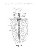 DENTAL IMPLANT SYSTEM diagram and image