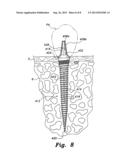 DENTAL IMPLANT SYSTEM diagram and image