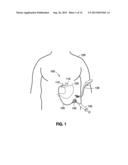 IMPLANTABLE ACCESS PORT SYSTEM diagram and image