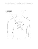 IMPLANTABLE MEDICAL DEVICE DELIVERY CATHETER WITH TETHER diagram and image