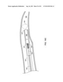 PASS-THROUGH IMPLANTABLE MEDICAL DEVICE DELIVERY CATHETER WITH REMOVEABLE     DISTAL TIP diagram and image