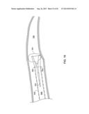 PASS-THROUGH IMPLANTABLE MEDICAL DEVICE DELIVERY CATHETER WITH REMOVEABLE     DISTAL TIP diagram and image