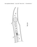 PASS-THROUGH IMPLANTABLE MEDICAL DEVICE DELIVERY CATHETER WITH REMOVEABLE     DISTAL TIP diagram and image