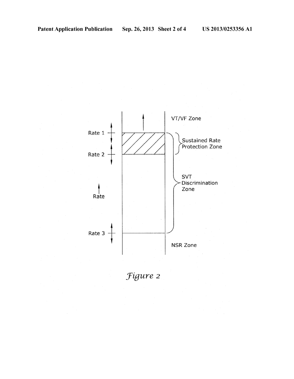 APPARATUS AND METHOD FOR IDENTIFYING ATRIAL ARRHYTHMIA BY FAR-FIELD     SENSING - diagram, schematic, and image 03