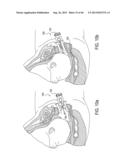 METHOD AND APPARATUS FOR PREVENTING VAGINAL LACERATIONS DURING CHILDBIRTH diagram and image