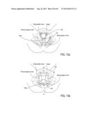 METHOD AND APPARATUS FOR PREVENTING VAGINAL LACERATIONS DURING CHILDBIRTH diagram and image