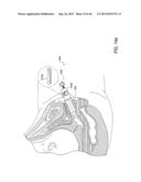 METHOD AND APPARATUS FOR PREVENTING VAGINAL LACERATIONS DURING CHILDBIRTH diagram and image