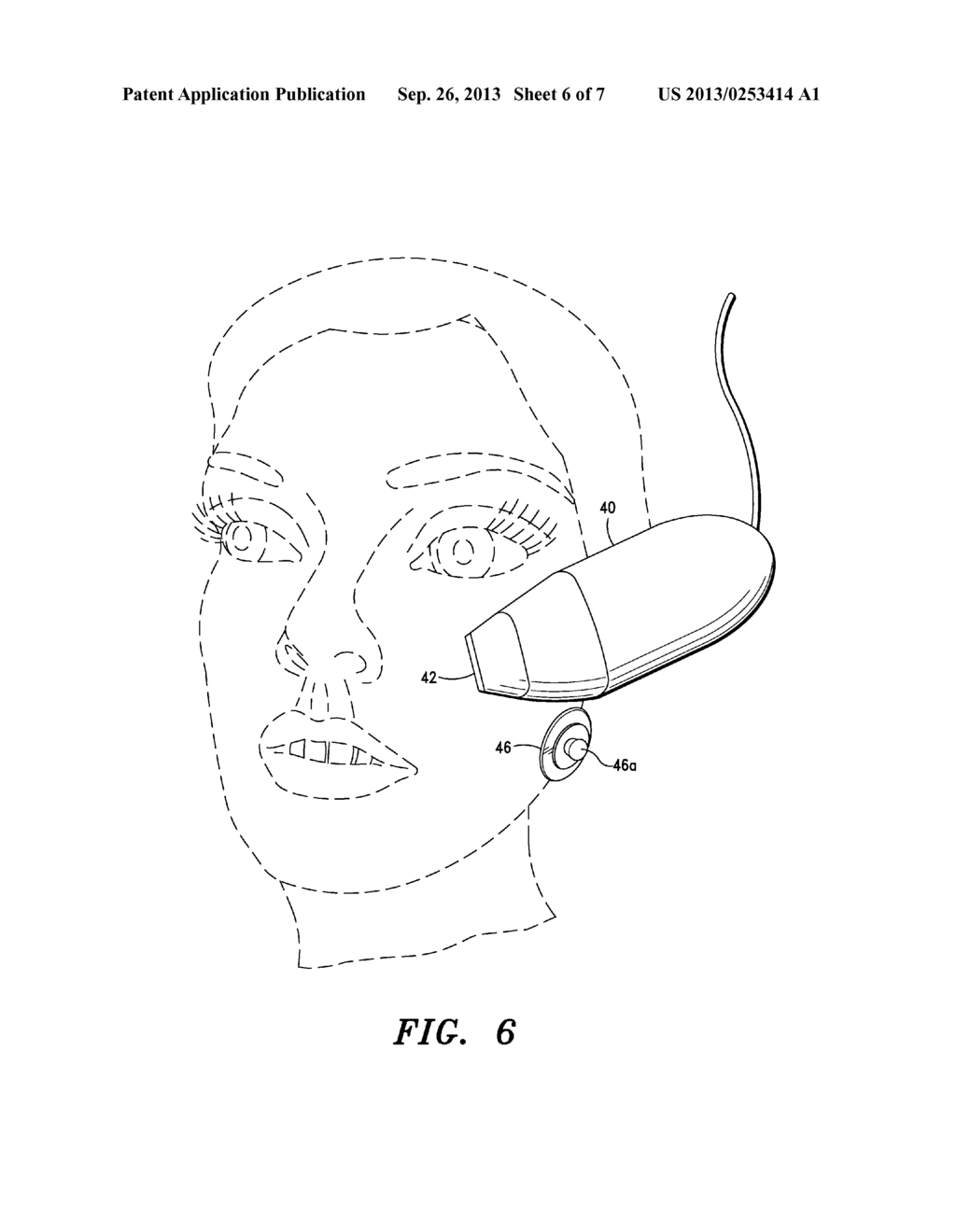 Method and Apparatus for Providing Topical Anesthesia Prior to and During     a Cosmetic Procedure - diagram, schematic, and image 07