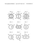 Manufacture of Split Tip Catheters diagram and image