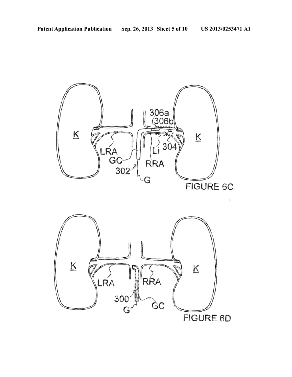 Methods and Apparatus for Treating Contrast Nephropathy - diagram, schematic, and image 06