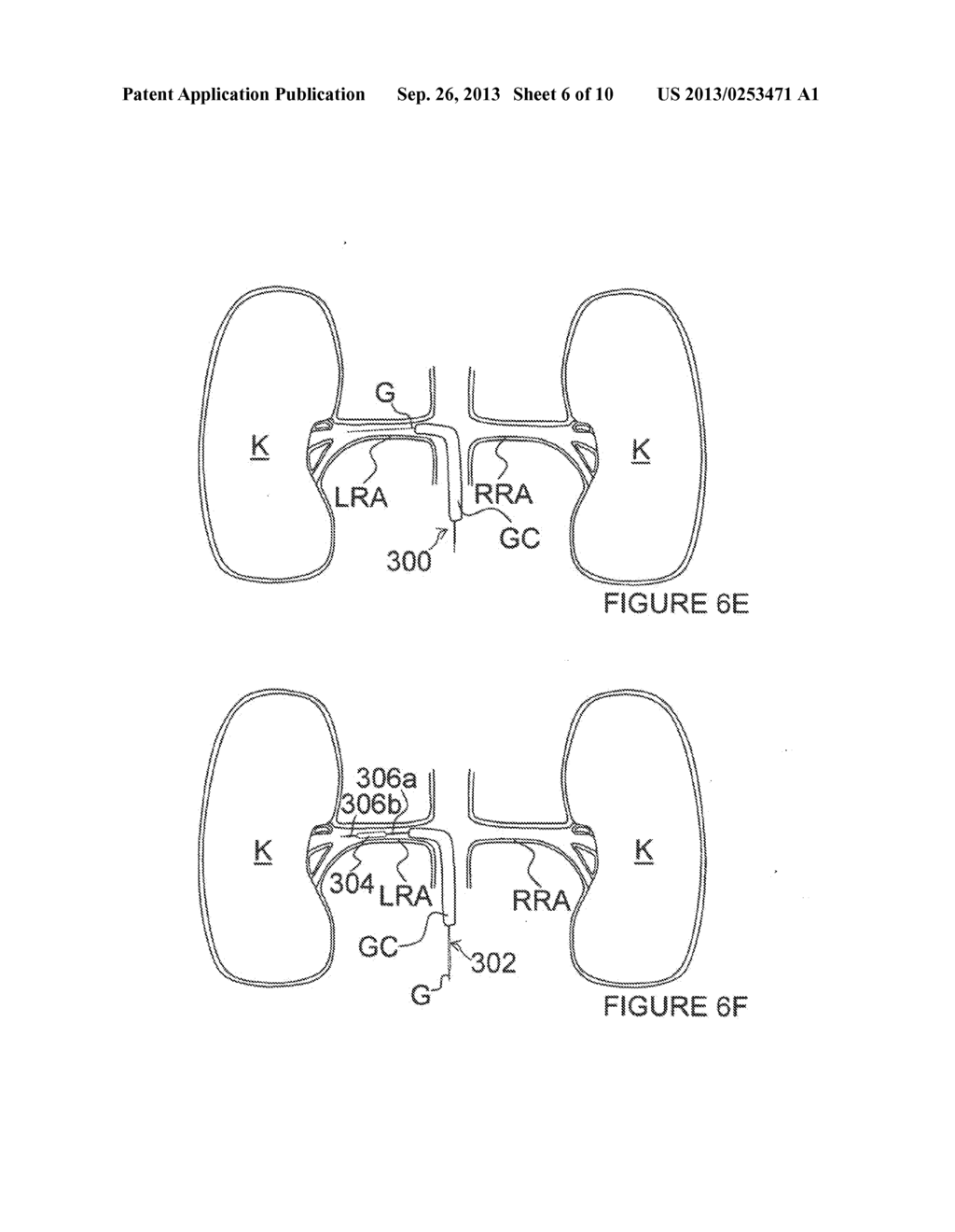 Methods and Apparatus for Treating Contrast Nephropathy - diagram, schematic, and image 07