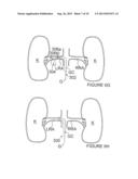 Methods and Apparatus for Treating Contrast Nephropathy diagram and image