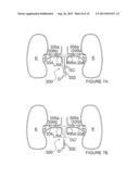 Methods and Apparatus for Treating Contrast Nephropathy diagram and image