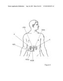 Methods and Apparatus for Treating Contrast Nephropathy diagram and image