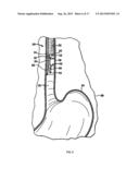 Cryosurgery System diagram and image