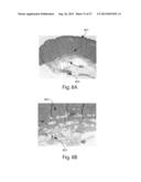 TREATMENT SYSTEMS FOR REMOVING HEAT FROM SUBCUTANEOUS LIPID-RICH CELLS diagram and image