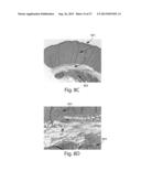 TREATMENT SYSTEMS FOR REMOVING HEAT FROM SUBCUTANEOUS LIPID-RICH CELLS diagram and image