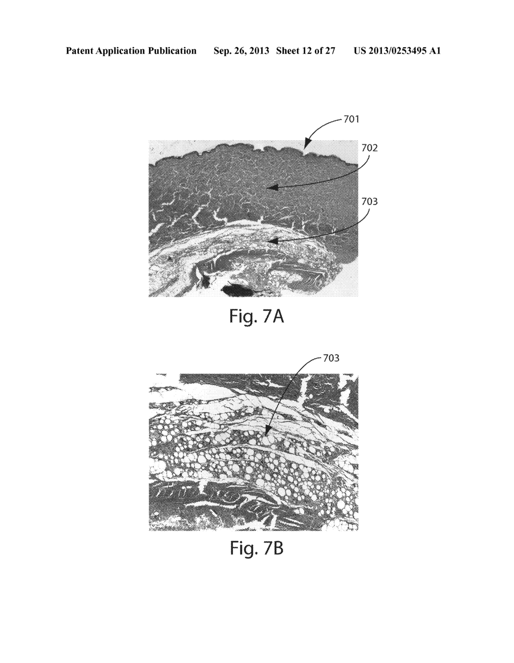 TREATMENT SYSTEMS FOR REMOVING HEAT FROM SUBCUTANEOUS LIPID-RICH CELLS AND     TREATMENT SYSTEMS FOR AFFECTING SUBCUTANEOUS LIPID-RICH CELLS - diagram, schematic, and image 13