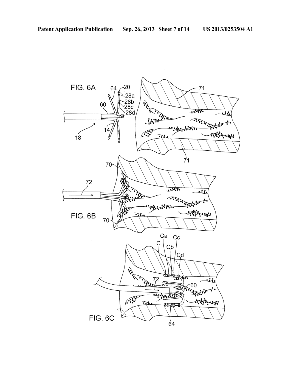 FLOWER CATHETER FOR MAPPING AND ABLATING VEINOUS AND OTHER TUBULAR     LOCATIONS - diagram, schematic, and image 08