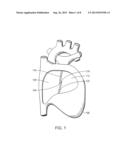 Device with Biological Tissue Scaffold for Percutaneous Closure of an     Intracardiac Defect and Methods Thereof diagram and image