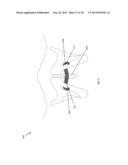 SUTURING DEVICE diagram and image