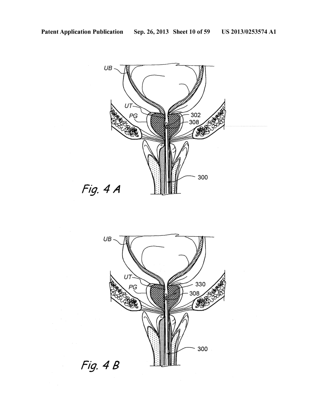 DEVICES, SYSTEMS AND METHODS FOR TREATING BENIGN PROSTATIC HYPERPLASIA AND     OTHER CONDITIONS - diagram, schematic, and image 11