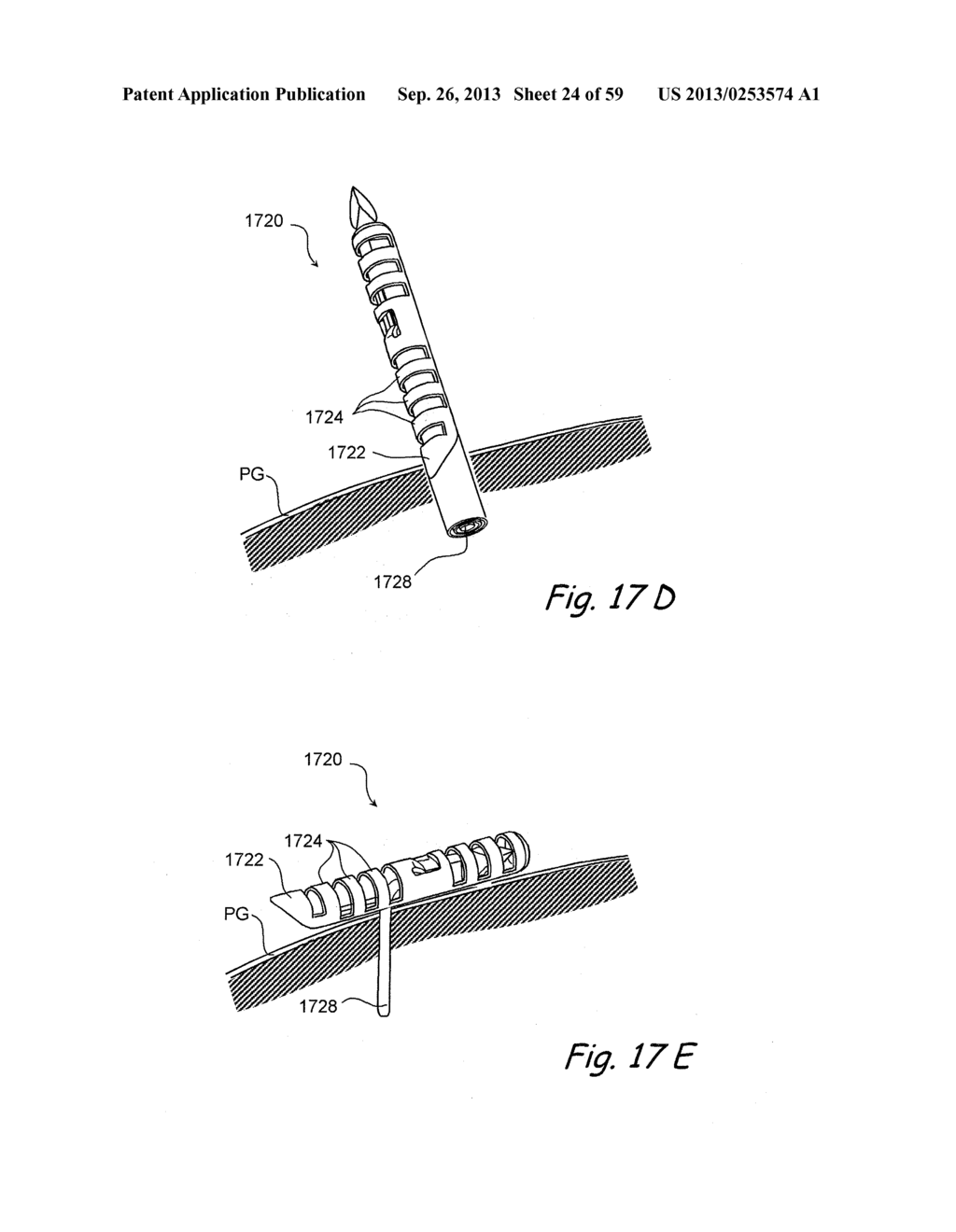 DEVICES, SYSTEMS AND METHODS FOR TREATING BENIGN PROSTATIC HYPERPLASIA AND     OTHER CONDITIONS - diagram, schematic, and image 25