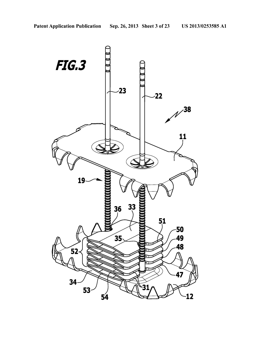 SURGICAL FIXATION SYSTEM, SPACER ELEMENT FOR A SURGICAL FIXATION SYSTEM,     USE OF AN IMPLANT AND METHOD FOR STABILIZING SPINOUS PROCESSES - diagram, schematic, and image 04