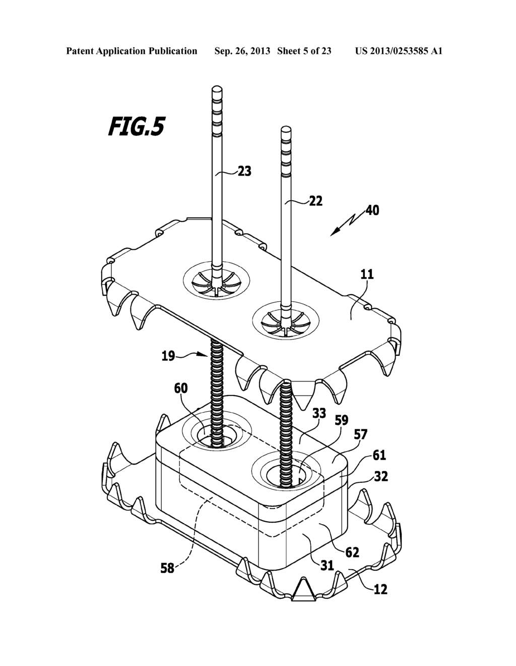 SURGICAL FIXATION SYSTEM, SPACER ELEMENT FOR A SURGICAL FIXATION SYSTEM,     USE OF AN IMPLANT AND METHOD FOR STABILIZING SPINOUS PROCESSES - diagram, schematic, and image 06