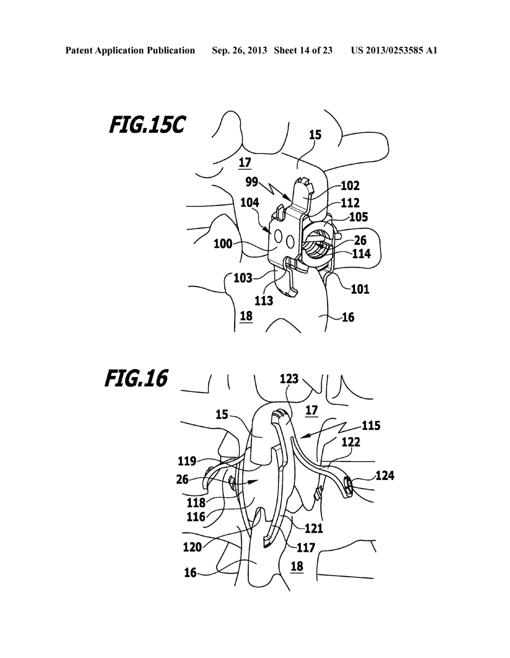 SURGICAL FIXATION SYSTEM, SPACER ELEMENT FOR A SURGICAL FIXATION SYSTEM,     USE OF AN IMPLANT AND METHOD FOR STABILIZING SPINOUS PROCESSES - diagram, schematic, and image 15