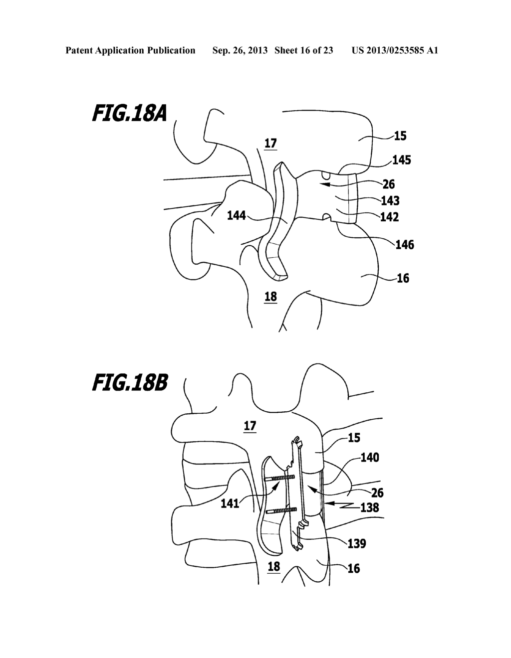 SURGICAL FIXATION SYSTEM, SPACER ELEMENT FOR A SURGICAL FIXATION SYSTEM,     USE OF AN IMPLANT AND METHOD FOR STABILIZING SPINOUS PROCESSES - diagram, schematic, and image 17