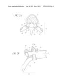 SIDE-BIASED ORTHOPEDIC FASTENER RETENTION diagram and image