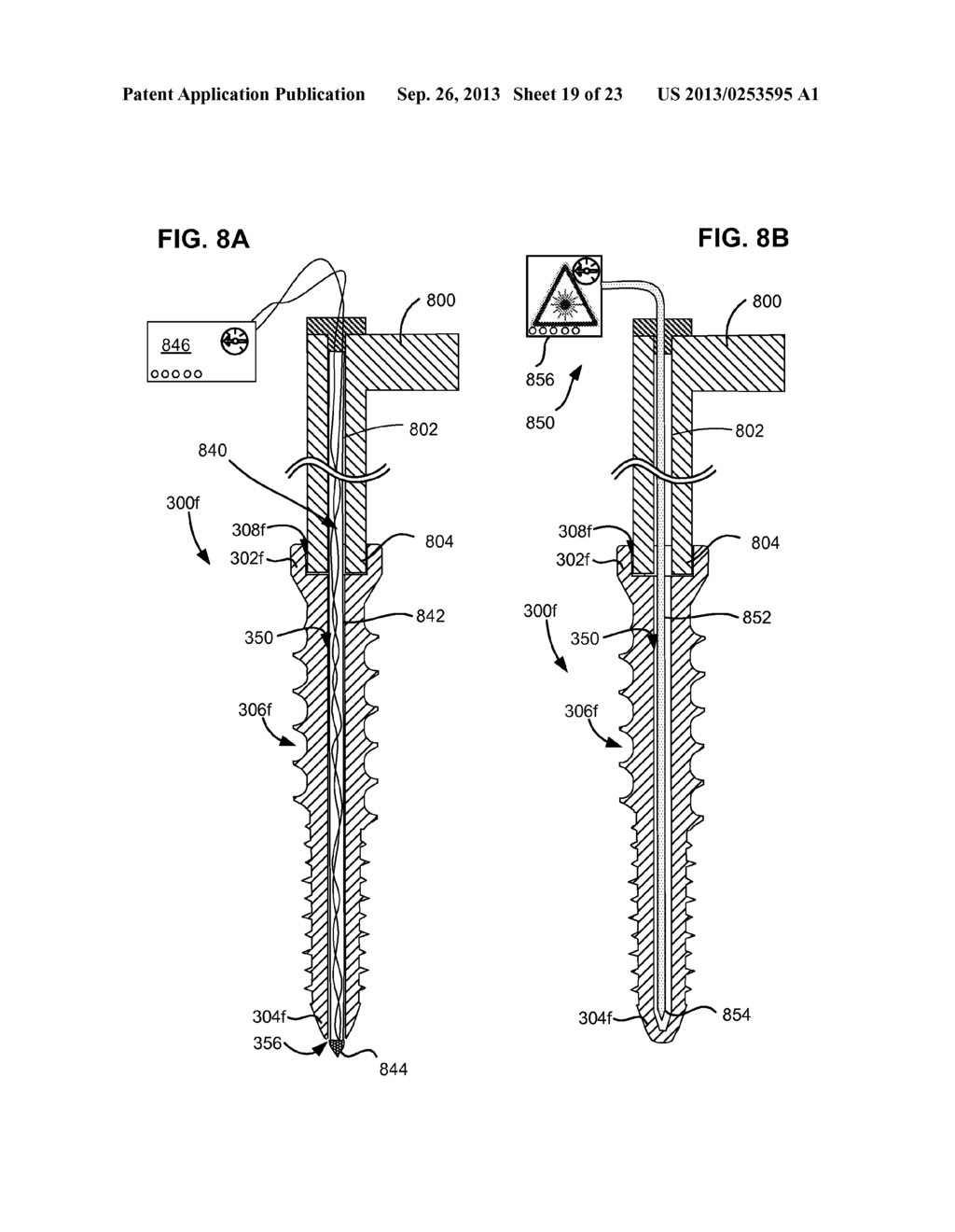 SYSTEM AND METHOD FOR SECURING AN IMPLANT TO A BONE CONTAINING BONE CEMENT - diagram, schematic, and image 20