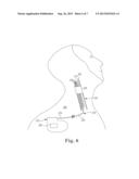 SYSTEMS AND METHODS FOR STIMULATION OF VAGUS NERVE diagram and image