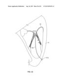 HEART VALVE CHORDAE REPLACEMENT METHODS AND APPARATUS diagram and image