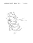 IMPLANTABLE FACET FUSION DEVICES diagram and image