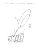 IMPLANTABLE FACET FUSION DEVICES diagram and image