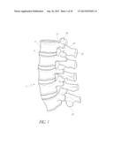 FLANGED INTERBODY FUSION DEVICE WITH FASTENER INSERT AND RETAINING RING diagram and image