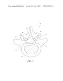 FLANGED INTERBODY FUSION DEVICE WITH FASTENER INSERT AND RETAINING RING diagram and image